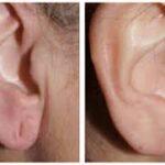 What Makes Someone a Good Candidate for Earlobe Repair?