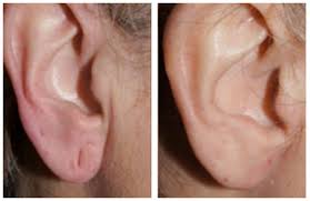 What Makes Someone a Good Candidate for Earlobe Repair?
