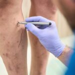 The Role of Education in Effective Vein Care