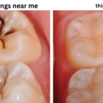 dental fillings near me