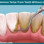 How to Remove Tartar From Teeth Without a Dentist