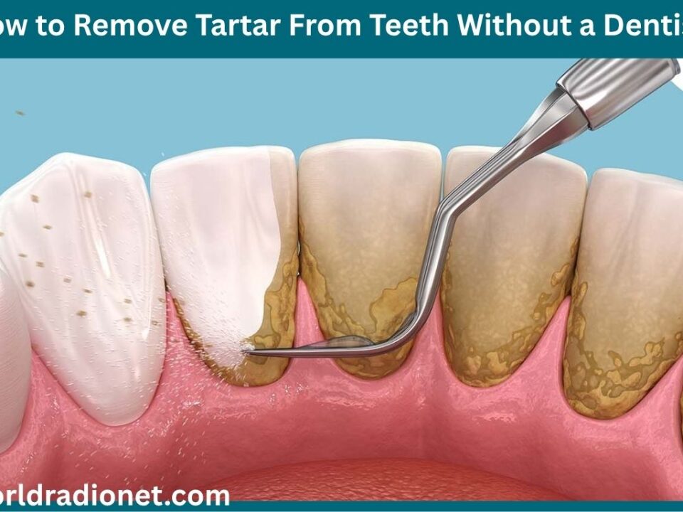 How to Remove Tartar From Teeth Without a Dentist